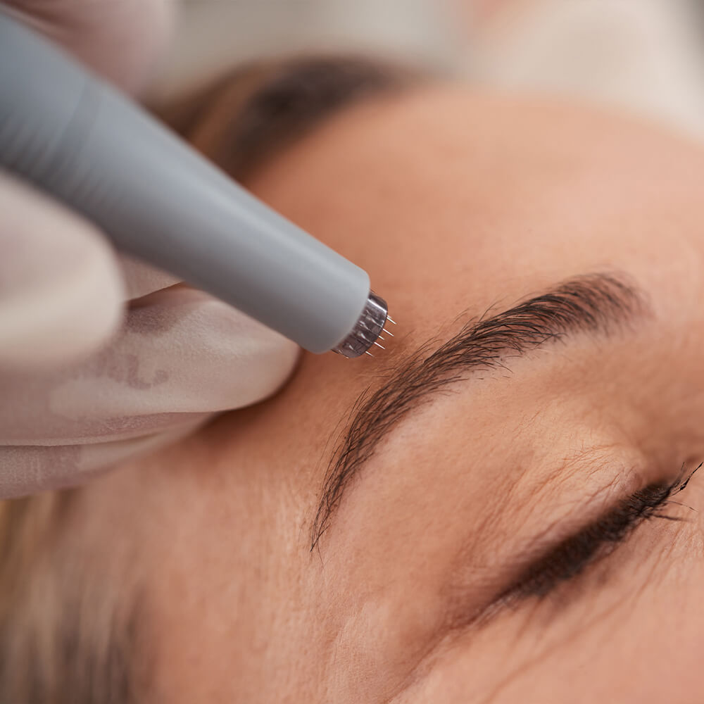 Micro Needling